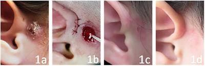 Summary of the Experience in the Diagnosis and Treatment of Complex Preauricular Fistulas in 78 Children
